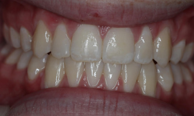 After treatment - Patient E