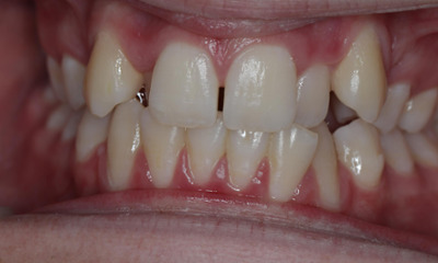 Before treatment - Patient E